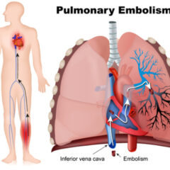 血液ドロドロは危ない！！（肺血栓塞栓症）