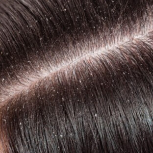 アタマの白い粉❆（フケ対策）